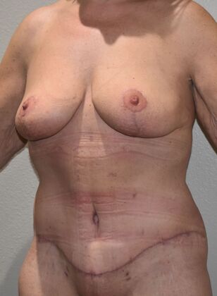 Massive Weight Loss : Case 165 - After