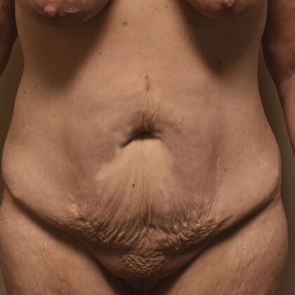 Tummy Tuck (Abdominoplasty): Case 518 - Before