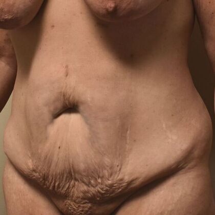 Tummy Tuck (Abdominoplasty): Case 518 - Before