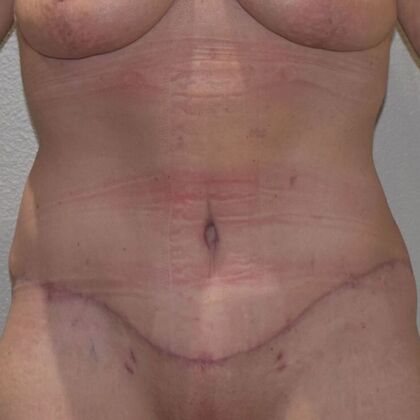 Tummy Tuck (Abdominoplasty): Case 518 - After