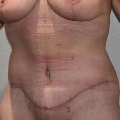 Tummy Tuck (Abdominoplasty): Case 518 - After
