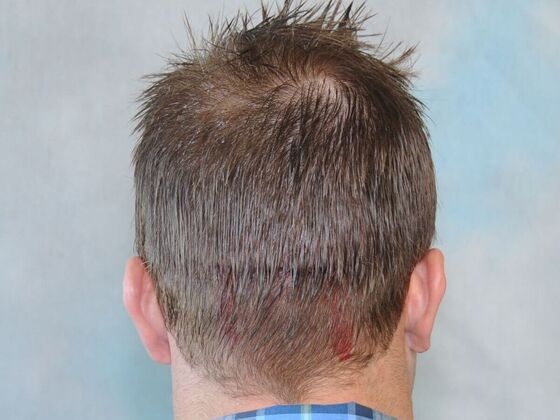 Hair Transplant Results: Case 4 - Before