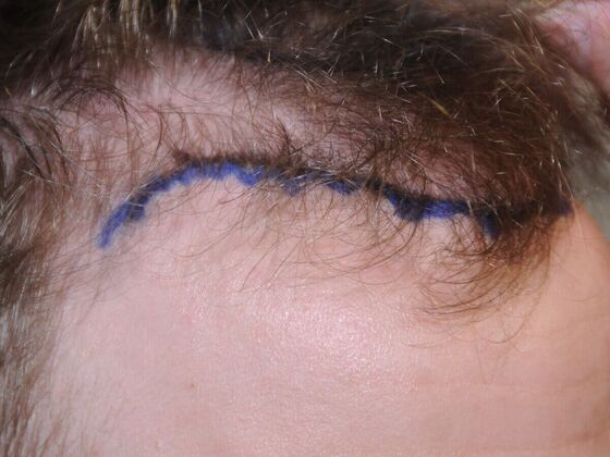 Hair Transplant Results: Case 4 - Before