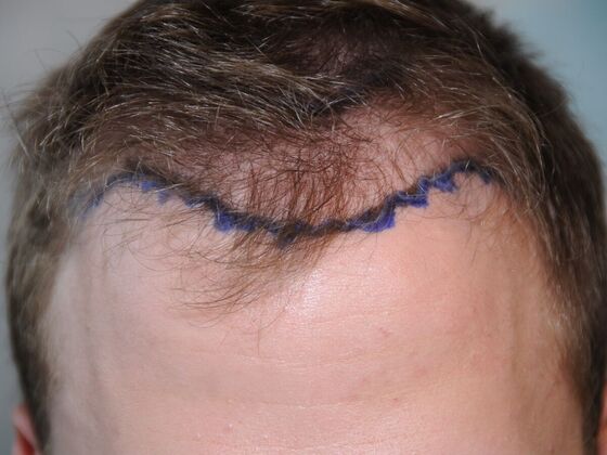 Hair Transplant Results Case 4 - Before