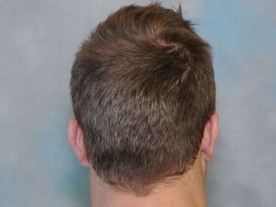 Hair Transplant Results: Case 4 - After