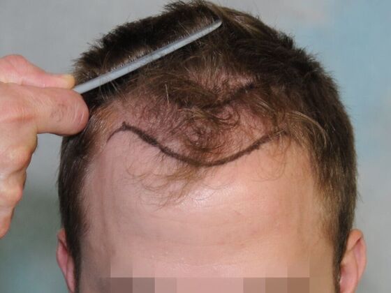 Hair Transplant Results: Case 4 - Before