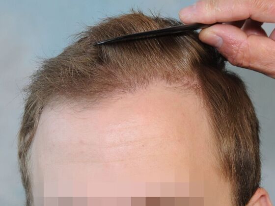 Hair Transplant Results: Case 4 - After