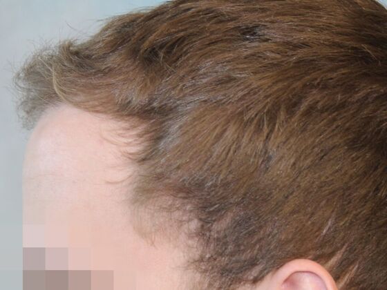 Hair Transplant Results: Case 4 - After