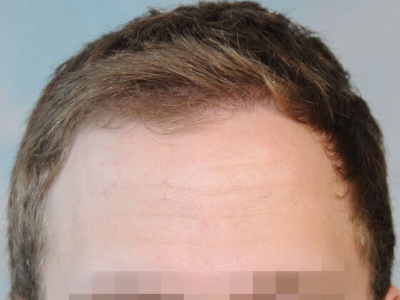 Hair Transplant Results Case 4 - After