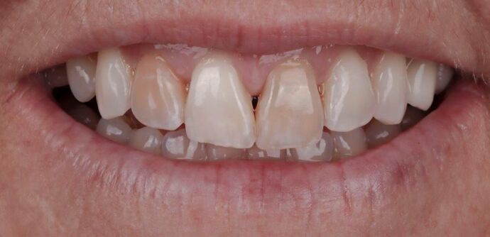 Smile Makeover & Veneers: Danielle - Before