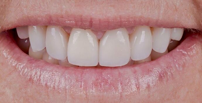 Smile Makeover & Veneers: Danielle - After