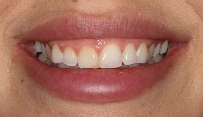 Smile Transformations Taylor - Before