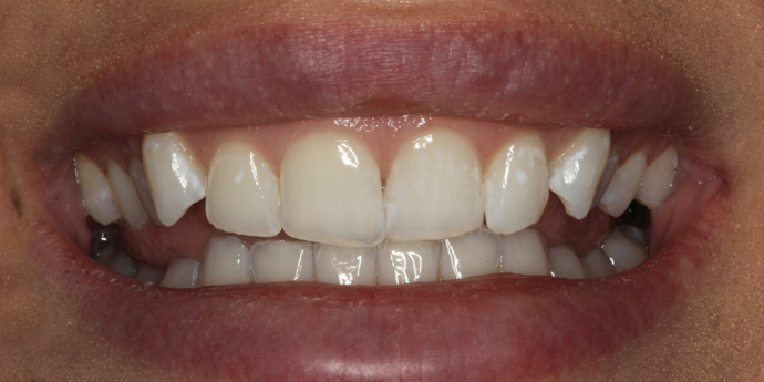 Smile Transformations Stephanie - Before