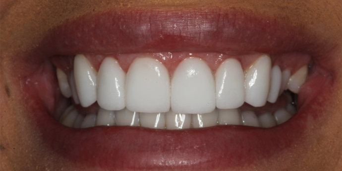 Smile Transformations Stephanie - After