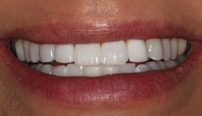 Smile Transformations Melissa - Before