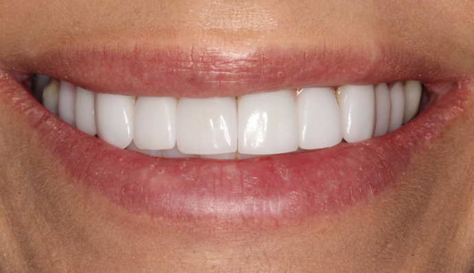 Smile Transformations Melissa - After