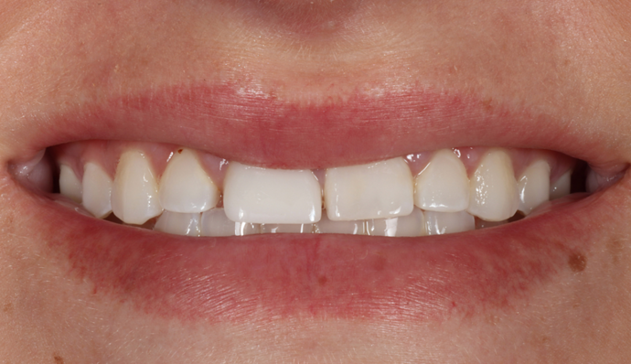 Smile Transformations Markessa - Before