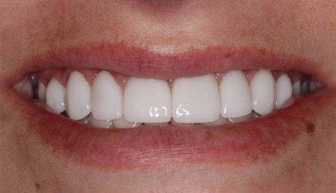 Smile Transformations Markessa - After