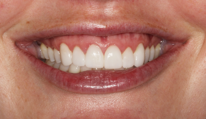 Smile Transformations Madie - After