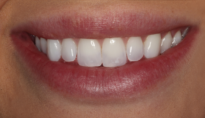 Smile Transformations Liz - Before