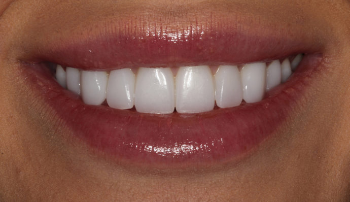 Smile Transformations Liz - After