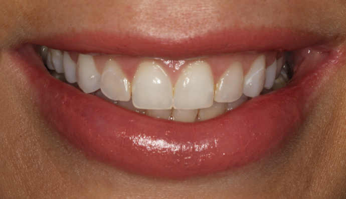 Smile Transformations LaTisha - Before