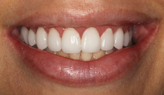 Smile Transformations LaTisha - After