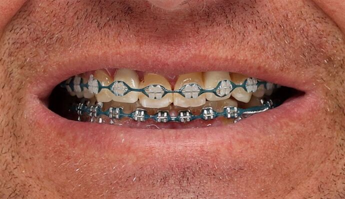 Smile Transformations Justin - Before