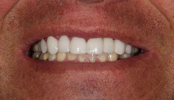 Smile Transformations Justin - After