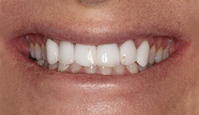 Smile Transformations Joelle - Before