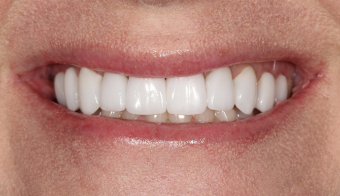 Smile Transformations Joelle - After