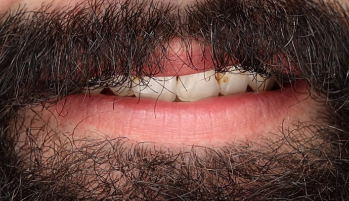 Smile Transformations Jasper - Before