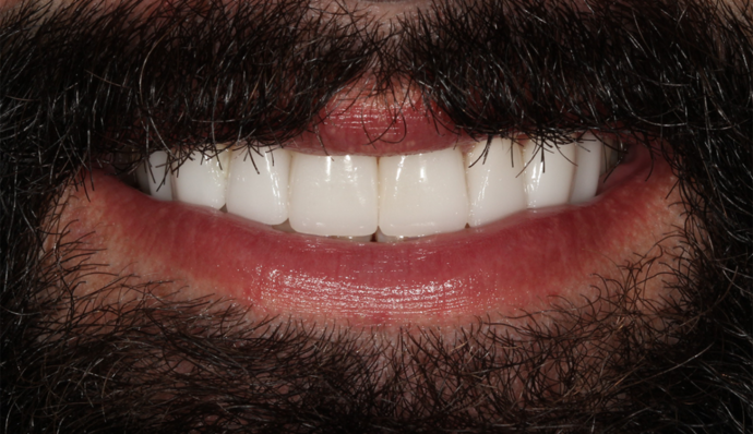 Smile Transformations Jasper - After