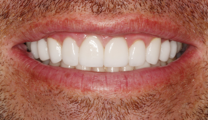 Smile Transformations Greg - After