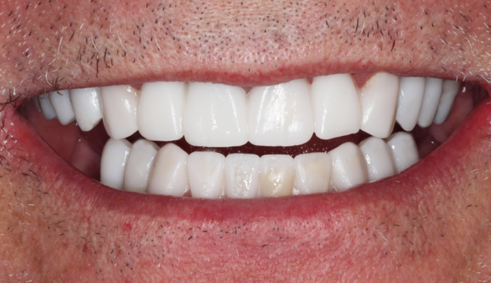 Smile Transformations Carl - After