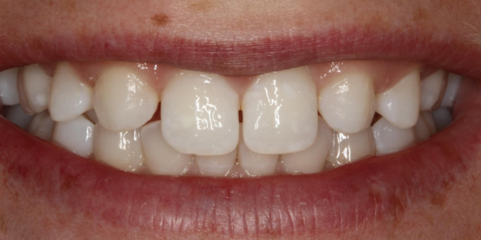 Smile Transformations Bethany - Before