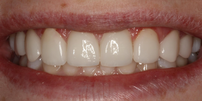 Smile Transformations Bethany - After