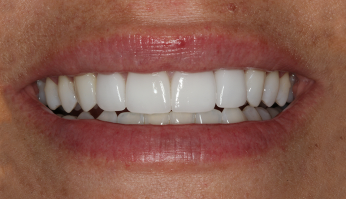 Smile Transformations Aja - After