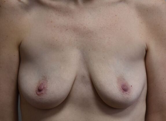 Breast Augmentation Case 782 - Before