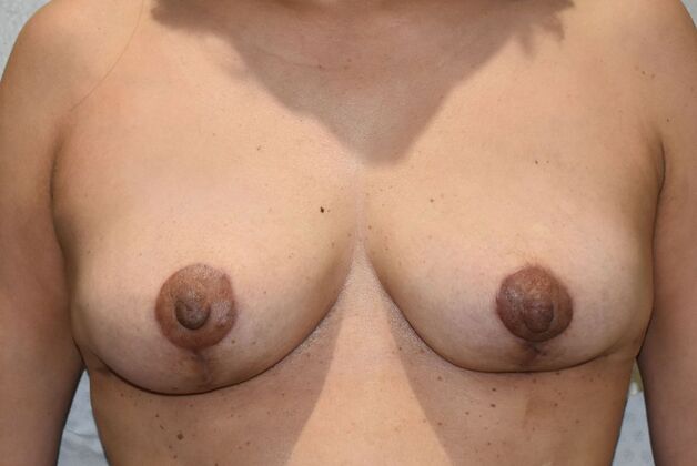 Breast Implant Removal: Case 46 - After
