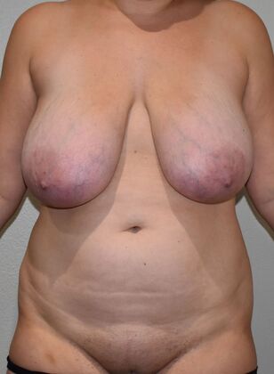 Mommy Makeover Case 330 - Before