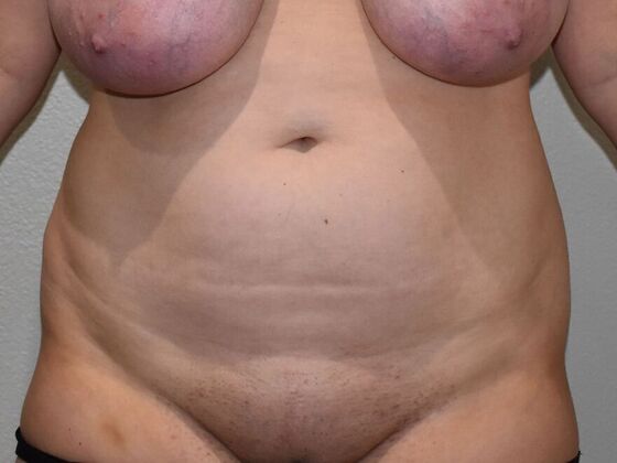 Tummy Tuck (Abdominoplasty): Case 519 - Before