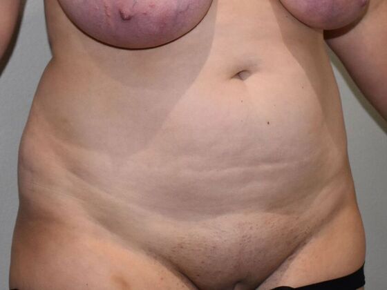 Tummy Tuck (Abdominoplasty): Case 519 - Before