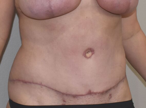 Tummy Tuck (Abdominoplasty): Case 519 - After