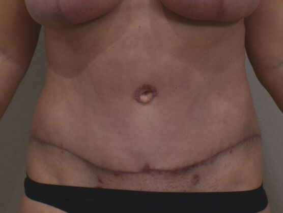 Tummy Tuck (Abdominoplasty): Case 519 - After