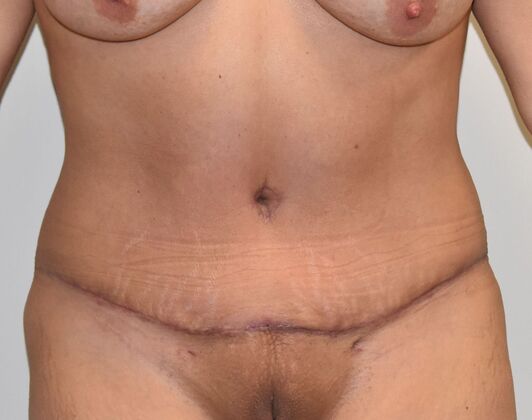 Tummy Tuck (Abdominoplasty): Case 520 - After