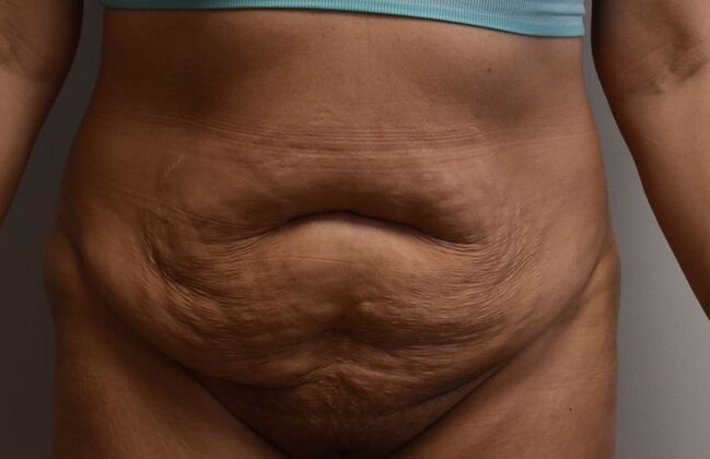 Tummy Tuck (Abdominoplasty): Case 520 - Before