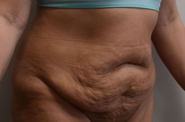 Tummy Tuck (Abdominoplasty): Case 520 - Before