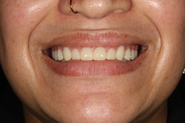 All-on-4 / All-on-X: Case 11 - Before