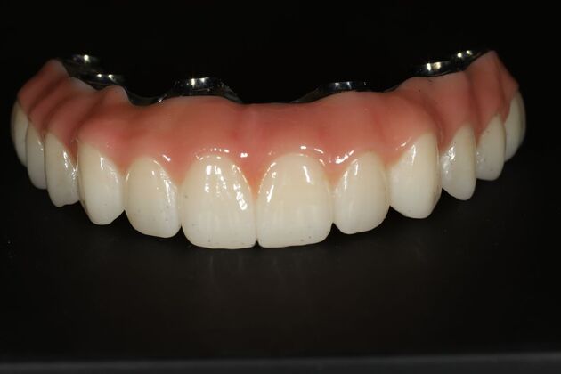 All-on-4 / All-on-X: Case 11 - After